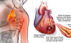 9.1 Penyakit Arteri Koroner | Buliran.com